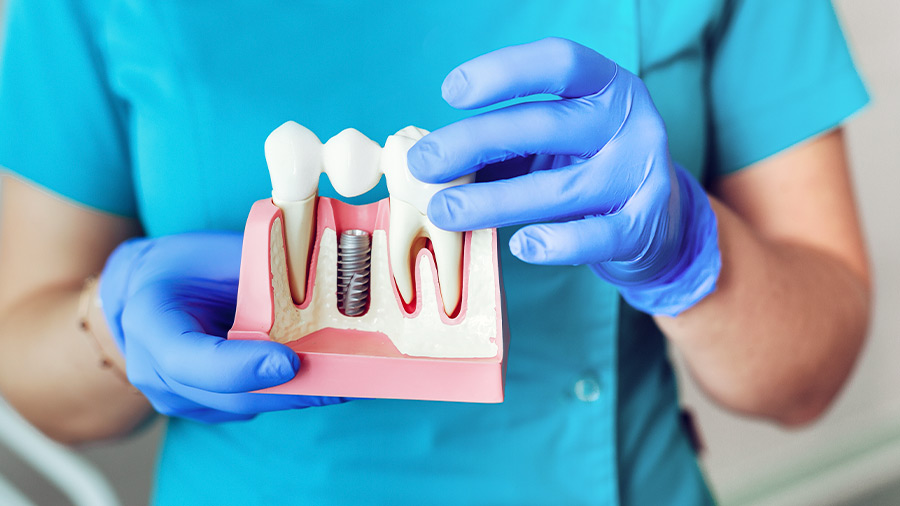 Un implante dental es un procedimiento seguro y eficaz