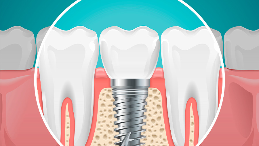 La implantología se especializa en tratamientos a través de implantes dentales