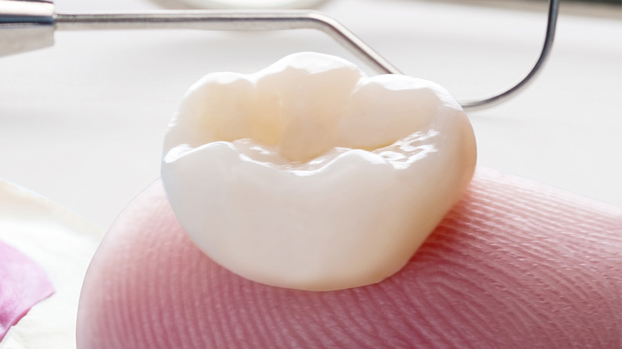 Las prótesis dentales fijas son muy utilizadas en el mundo de la odontología