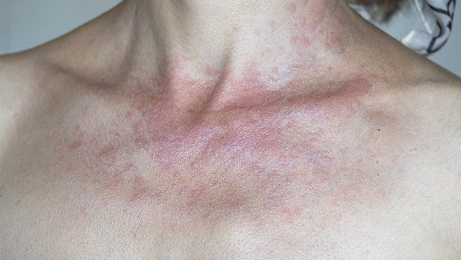 Dermatitis