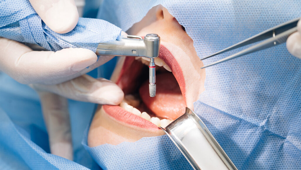 Colocación de implante dental