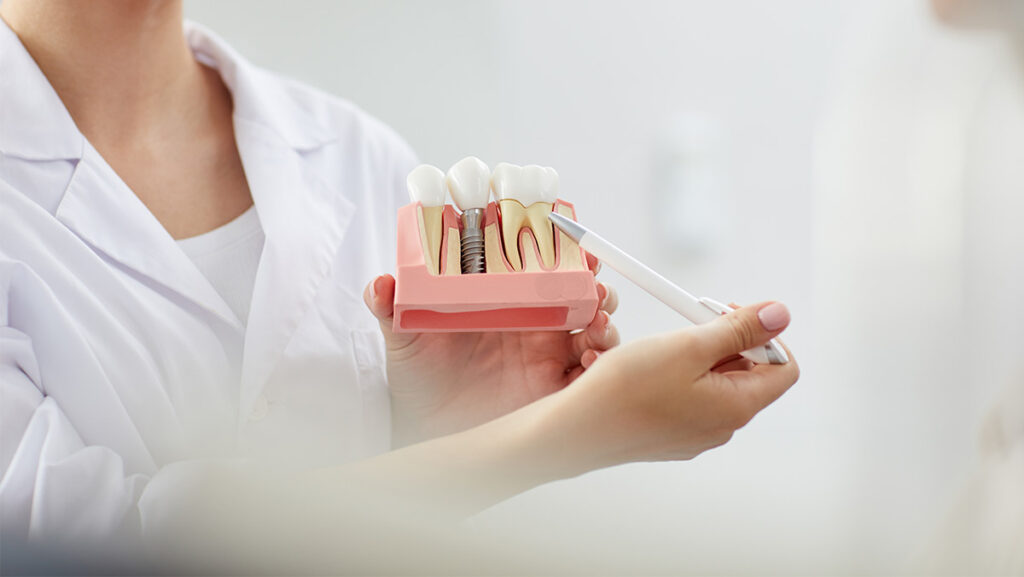 Modelo de implante dental