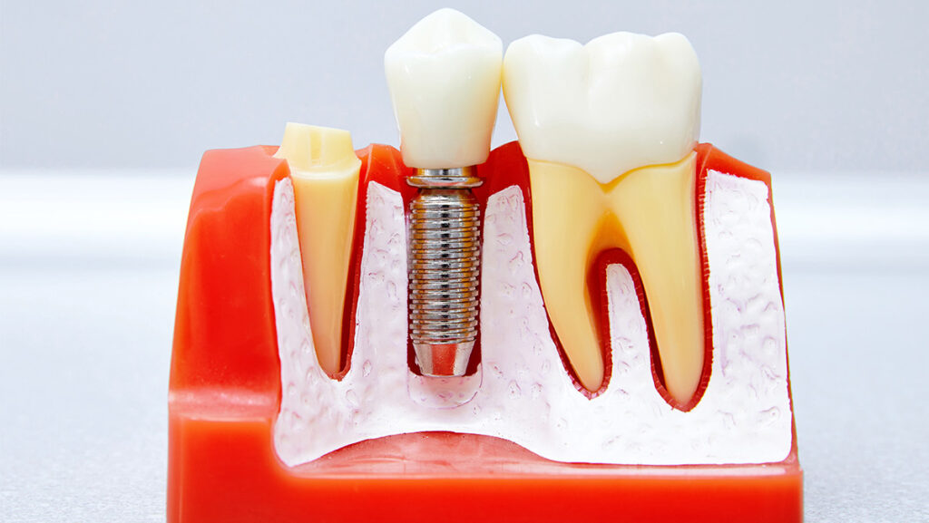 Modelo de implante dental