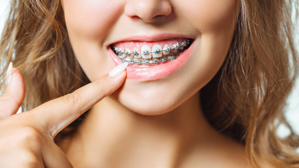 Mujer con brackets