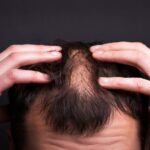 Causas de la alopecia: ¿Qué provoca la caída del cabello?