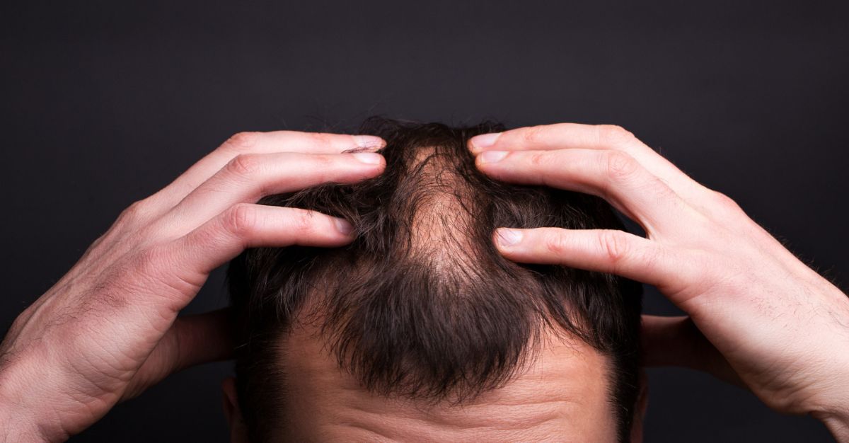 Causas de la alopecia: ¿Qué provoca la caída del cabello?